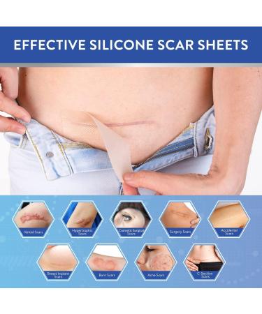Retailio Silicone Scar Sheets - Soften, Flatten Scars, C-Section, Keloid Surgery - Reusable, Washable - 1.6x60 - Buy Online on GoSupps.com