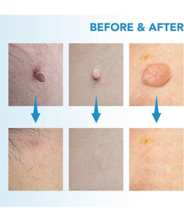 Skin Tag Tool Kit 2 in 1 Upgrade For Small to Large Skin Tags (2-8mm) Painless Fast and Easy Skin Tag Removal Kit Tools with 40 Removal Bands & 10 pcs Cleansing Wipes Easy to Use - Blue - Buy Online on GoSupps.com