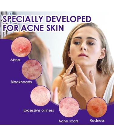 Halercay 20g acne cream reduces the volume of pimples effectively improves pimples on the face removes acne for pimpleprone skin makes the skin look smooth - Buy Online on GoSupps.com
