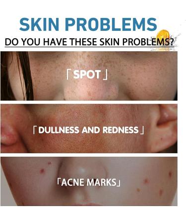 Acne Serum With Plant-Based Formula Dark Spot Correcting Glow Serum Dark Spot Serum Brightening Serum Hydrating Serum Improve Redness And Blemishes Smoothing & Calming Suitable For All Skin Types - Buy Online on GoSupps.com