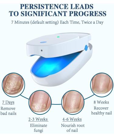 iKeener Nail Fungus Light Treatment Device For Toenail Toe Nail Fungus Treatment Extra Strength With 407nm Blue Light&905nm Light For Nail Fungus& Onychomycosis Fingernail Fungus Removal At Home HZJ-01 - Buy Online on GoSupps.com