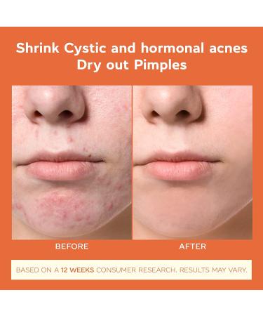 Cystic Hormonal and Severe Acne Treatment Cream - Anti Acne Ingredients, USA Designed, Japan Formulated (100ml/3.38oz) - Buy Online on GoSupps.com