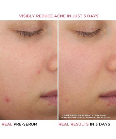 IT Cosmetics Bye Bye Breakout Acne Treatment Serum | 2% Salicylic Acid | Reduce Pimples in 3 Days | Fades Post-Acne Marks in 8 Weeks | 1 fl oz - Buy Online on GoSupps.com