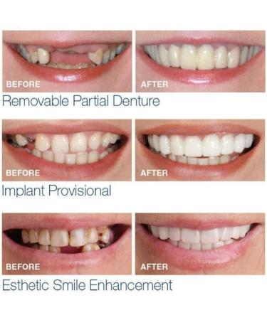 Denture Pebble Gel - Instant Repair for Upper & Lower Jaw | 3 Pairs for Confident Smiles | Quick & Easy Provisional Dentures - Buy Online on GoSupps.com