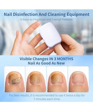 Nail Fungus Cleaning Light Device - Effective Rechargeable Remedy for Damaged Discolored Toenails & Fingernails - Fast Shipping Worldwide - Buy Online on GoSupps.com