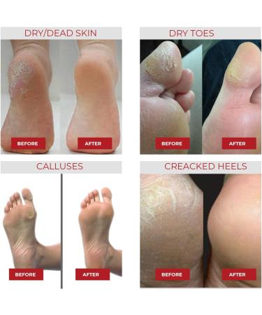 Exfoliating Foot Peel Mask For Softer Smooth Feet- Gently Peel Away Calluses & Dead Skin Repair Rough Heels Get Beautiful Baby Feet in 7 Days (2 Pack) - Buy Online on GoSupps.com