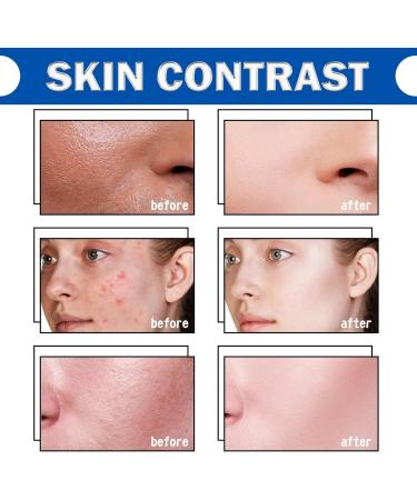 Azelaic Acid Serum Cream Azelaic Acid 12% Facial Serum Hydrating Serum with Vitamin C for Acne Redness Dark Spot Anti Aging Serum for Face Face Skin Care Beauty Brightening Serum for All Skin Types - Buy Online on GoSupps.com
