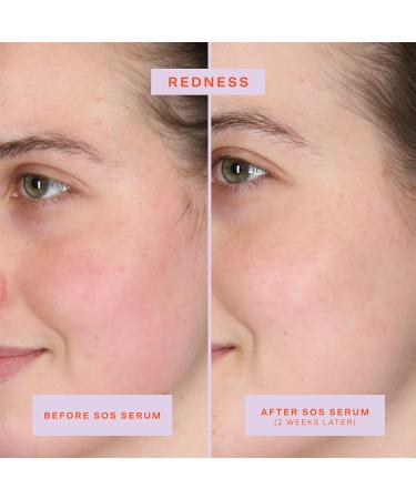 Tower 28 SOS Intensive Rescue Serum - Reduce Redness, Hypochlorous Acid for Sensitive Skin - 2 Fl Oz - Buy Online on GoSupps.com