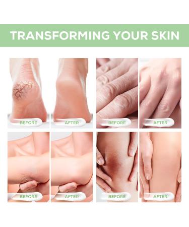 Urea Cream 40% Urea Foot Cream Cracked Heel Repair Cream For Feet and Hand for Deep Moisturizing Callus Remover Nourishes Soften For Feet Knees Hand 120g - Buy Online on GoSupps.com