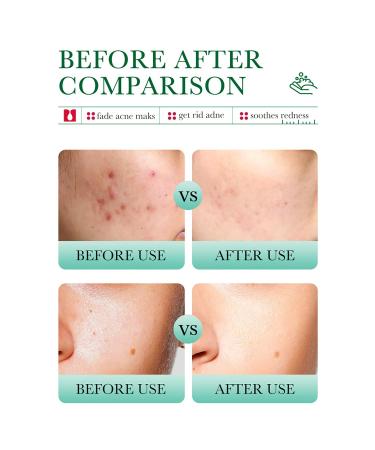 BIOAQUA Salicylic Acid Cleanser - Acne Marks Removal & Pore Shrink | 100g Deep Foam Cleanser - Buy Online on GoSupps.com