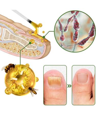 Furzero Nail Defense Bee Venom Serum: Nail Growth & Repair Treatment for Stronger Healthier Nails - Buy Online on GoSupps.com