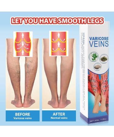 3Pcs Varicose Veins Treatment Set - Heal Veins, Improve Circulation - 90ml Spray - Buy Online on GoSupps.com