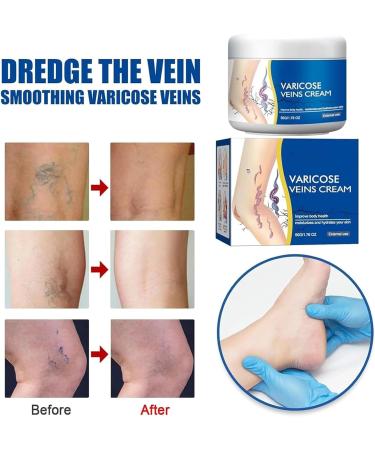 Traitement des varices pour les jambes la cr me de varices de jambe Varicose soulager l'enflure et la lourdeur 50g / 1 76fl.oz (1pcs) - Buy Online on GoSupps.com