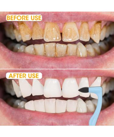 Fluhaw 3-Piece Tartar Remover Set - Professional Tooth Cleaner & Whitening Tools for Discoloration Removal - Buy Online on GoSupps.com