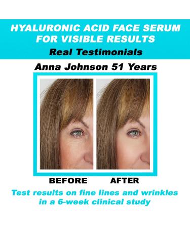 Pure Hyaluronic Acid Serum - Anti-Aging for Face Reduces Fine Lines Dark Spots & Hydrates Dry Skin - 2 oz - Buy Online on GoSupps.com
