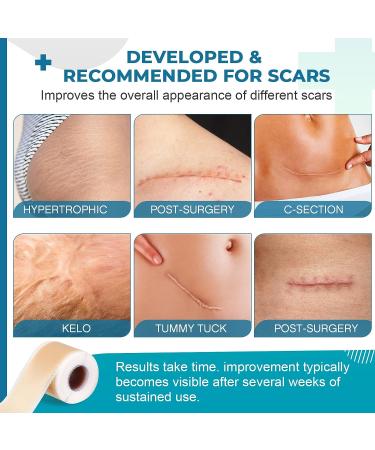 Silicone Scar Sheets Tape (1.6 x 60 Roll) - Professional Scar Removal for Surgical Scars, Keloid, C-Section, Burn, Acne - Brown - Buy Online on GoSupps.com
