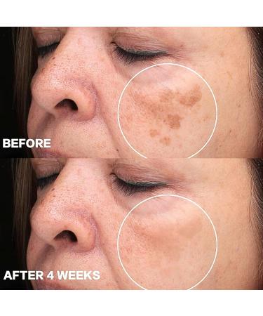 IZBEAUVO Dark Spot Remover for Face and Body Freckle Removal Cream Pigmentation Removal Cream Dark Spot Corrector Cream for Sun Spots Melasma Freckle Dark Spot Sun Spot Age Spot - Buy Online on GoSupps.com