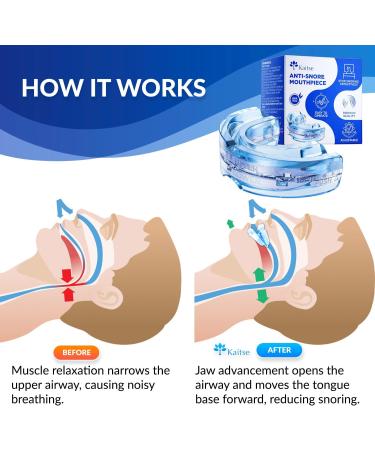 Kaitse Anti Snoring Devices for Sleep: Snoring Solution - Anti Snoring Mouth Guard - Effective Anti-Snoring Mouthpiece Stop Snoring - Buy Online on GoSupps.com