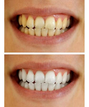 Teeth Whitening Gel 35% Carbamide Peroxide Professional Dispenser - 3 Pack (30ml each) - Buy Online on GoSupps.com