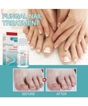 Fungal Nail Treatment Solution for Toenails & Fingernails - Repair and Strengthen Nails - Anti-fungal Nail Care - Buy Online on GoSupps.com