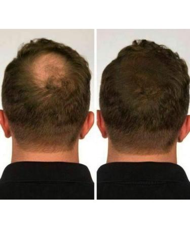 100% Natural Keratin Hair Fibre Refill for Hair Loss - Alopecia & Chemotherapy (25g Black) - Pack of 1 - Buy Online on GoSupps.com