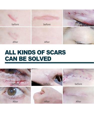 Advanced Scar Gel 2Pcs 50ml - Stretch Marks & Scars Remover with Allantoin & Vitamin E - Hydrating & Smoothing Formula for Old & New Scars - Buy Online on GoSupps.com