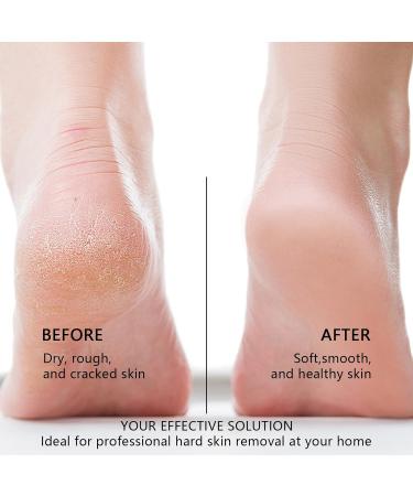 Foot Exfoliator Electric Rechargeable Feet Scrubber with 3 Rollers 3 Speeds IPX7 Waterproof Foot Care Pedicure Tools to Remove Cracked Heels Callus and Dead Skin Softly - Buy Online on GoSupps.com