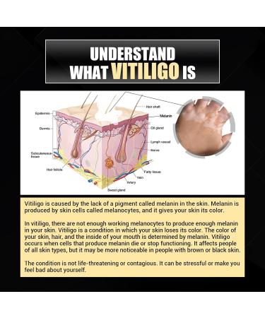 NONROT Vitiligo Skin Repair Spray - Reduces White Spots - 4 Count (Pack of 4) - Buy Online on GoSupps.com