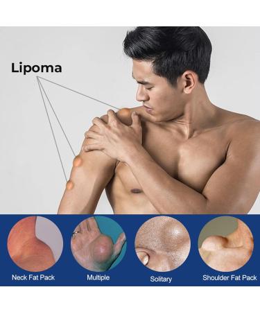 Cr me Naturelle D' limination des Lipomes Cr me D' limination des Lipomes V g taux Lipoma Elimination Cream Doux et Non Stimulant 1PC - Buy Online on GoSupps.com