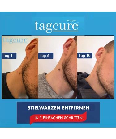 Tagcure Skin Tags Remover Kit - Easy Wart Mole & Skin Tag Removal at Home - 'Plus' Device for 0.5cm+ Skin Tags - Buy Online on GoSupps.com