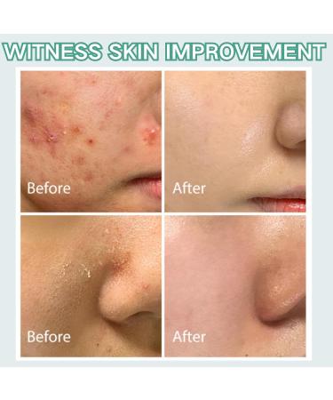 Salicylic Acid Face Moisturizer - Face Cream for Women - Acne Repair Face Cream - Spot Cream for Acne & Pimple - Moisturizer Face with Salicylic Acid - Improves Acne & Brightens Skin 20g - Buy Online on GoSupps.com