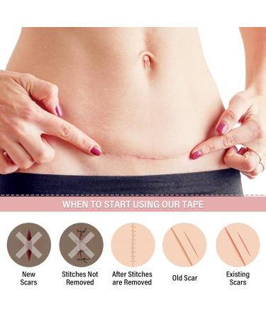Silicone Scar Sheets (4cm*3m) - Nude Color Silicone Tape for Scar Treatment - Buy Online on GoSupps.com