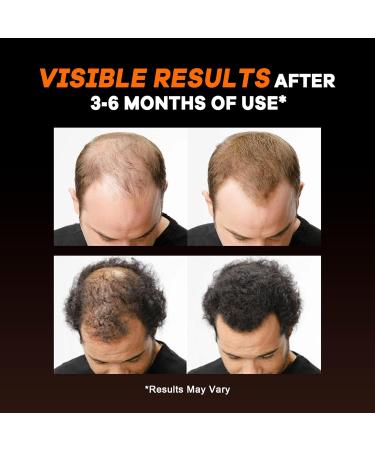 DHT Blocker for Men Hair Growth: Natural Hair Loss Supplement - Formula with 10000mcg Biotin & Saw Palmetto for Mens thinning Support - 1 Monthly Supply 60 Count (Pack of 1) - Buy Online on GoSupps.com