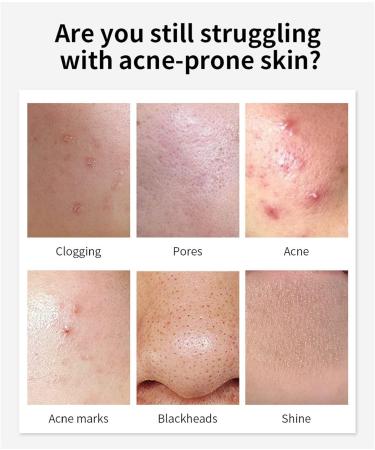 Anti Acne Removal Cream - Acne Treatment Spot and Blackheads Treatment - Day & Night Acne Gel Set - Moisturizing Skincare Fade Acne Spots Oil Control Shrink Pores - For All Skin Types 2x30ml - Buy Online on GoSupps.com