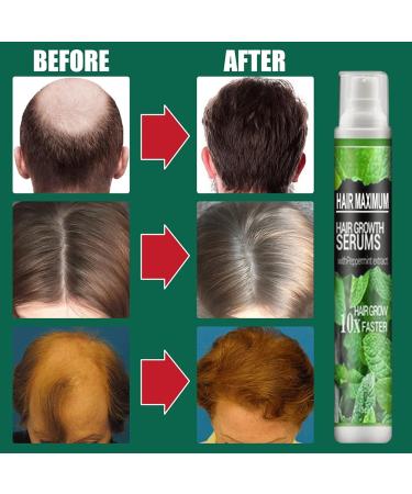 Herbal Hair-Growth Essence Spray - Anti Hair Loss Fast Grow Treatments Set - Buy Online on GoSupps.com