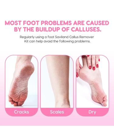 Saviland Callus Remover Kit - 8.45 fl Oz Gel for Dead Skin Removal with Foot File, Scrubber, Pumice Stone, and Gloves - Pedicure Set for Foot Care and Spa Treatment at Home - Buy Online on GoSupps.com