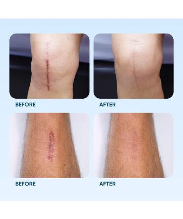 Silicone Scar Removal Sheets - Reusable & Waterproof Patches for C-Section, Burn, Acne, Stretch Marks - 4 Sheets - Buy Online on GoSupps.com