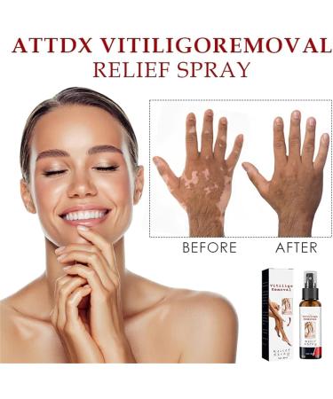 DUBUSH Vitiligo & Psoriasis Relief Spray - Skin Repair Treatment for Reducing White Spots - Soothing & Moisturizing Formula - 1 Pcs - Buy Online on GoSupps.com