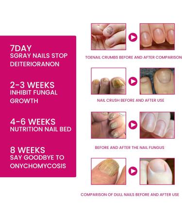  G n rique Nail Hardener Nails Nutrient Oil 10ml Natural Cuticle Oils Repair Softener Optimal Nail Revitalization for Foot Care Fingernails Yellow Toenail Ingrown Women and Men - Buy Online on GoSupps.com