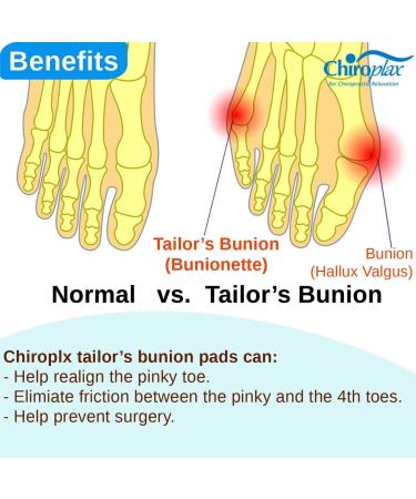 Chiroplax Tailor's Bunion Corrector Pads - Pain Relief Pinky Toe Straightener Separator Kit - Buy Online on GoSupps.com