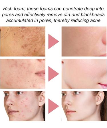 5 In 1 Cleansing Face Wash Foaming Cream Cleanser Water Based Cleanser Natural Foaming Cleaner Skin Care with Niacinamide Hyaluronic Acid Removes Excess Oil Unclogs Pores Reduces Blackheads - Buy Online on GoSupps.com