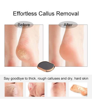 Acpetdr Foot File Glass Foot Callus Remover Callus Remover and Heel Scraper Foot Grinding Scraper Foot Scrubber for Wet and Dry feet Removal Hard or Dead Skin for Women or Men - Buy Online on GoSupps.com