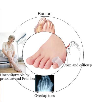 Yimanduo Gel Toe Splints 10 Pack Hammer Toe Separators for Men Women Walking Running Overlap Bunion Corrector Bunion Relief ( - Buy Online on GoSupps.com