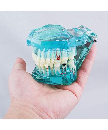 Buy Lmeil Transparent Dental Teeth Model - Ideal for Implantation & Dentist Research | Pathological Dental Model - Buy Online on GoSupps.com