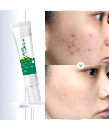 Anti Acne Face Cream Acne Treatment Cream Acne Cream Acne Spot Treatment Acne Scar Treatment Tea Tree Cream Acnecide Gel Skin Treatment Gel Cream For Face Blemishes & Blackheads 20G - Buy Online on GoSupps.com