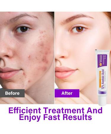  Generisch Azelaic Acid Serum 12% 20g Azelaic Acid Cream Effectively Relieves Facial Redness and Inflammation Lightens Discolorations a - Buy Online on GoSupps.com