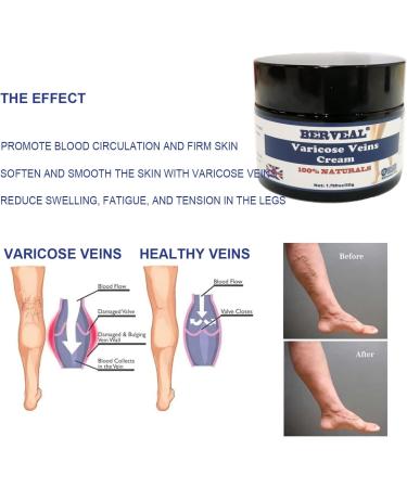 Effective Varicose Veins Cream for Legs | Relieve Spider Veins & Improve Blood Circulation | 1 Pack - Buy Online on GoSupps.com