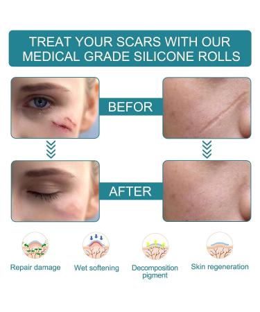 Silicone Scar Sheets 1.6x60 inches - Professional Scar Removal for C-Section, Surgery, Burn, Keloid & Acne - Buy Online on GoSupps.com