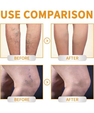 EXQST Fivfivgo Varicose Veins Miracle Cream Treatment Cream for Varicose Veins Improves Circulation - Buy Online on GoSupps.com