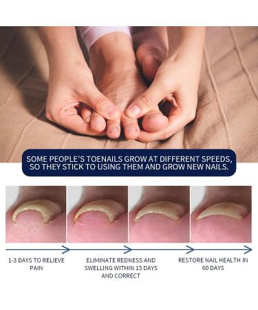 German Toenailcare Removal Paronychia Oil - 2 Pcs Set for Ingrown Toenail Treatment and Softening Embedded Toenails - Buy Online on GoSupps.com
